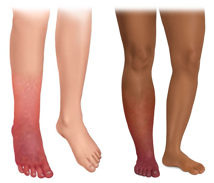 Die fotorealistische Darstellung zeigt einen Unterschenkel mit Phlegmone auf heller (links) und dunklerer Haut. Die Entzündung reicht in tiefere Hautschichten und Gewebe.