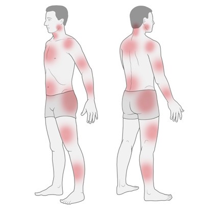 Grafik: Mögliche Schmerzbereiche bei Fibromyalgie - wie im Text beschrieben