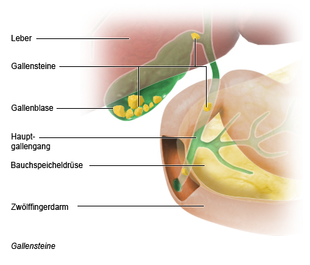 Grafik: Darstellung von Gallensteinen - wie im Text beschrieben