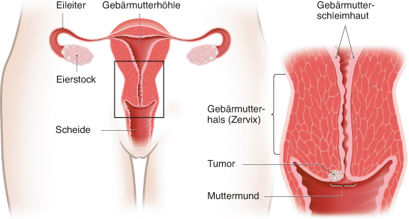 Grafik: Gebärmutterhals und Muttermund