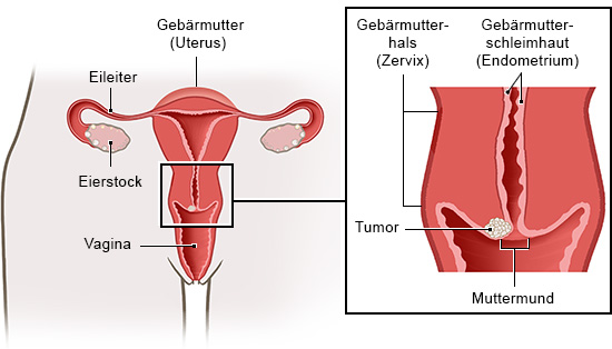 Die anatomische Grafik links zeigt die inneren weiblichen Geschlechtsorgane, die Grafik rechts den Gebärmutterhals und einen Tumor am Muttermund.