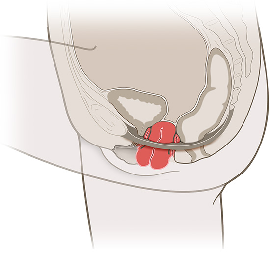 Die vereinfachte anatomische Grafik zeigt einen Gebärmuttervorfall (in rot).
