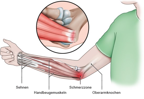 Grafik: Schmerzregion bei Golferarm - wie im Text beschrieben