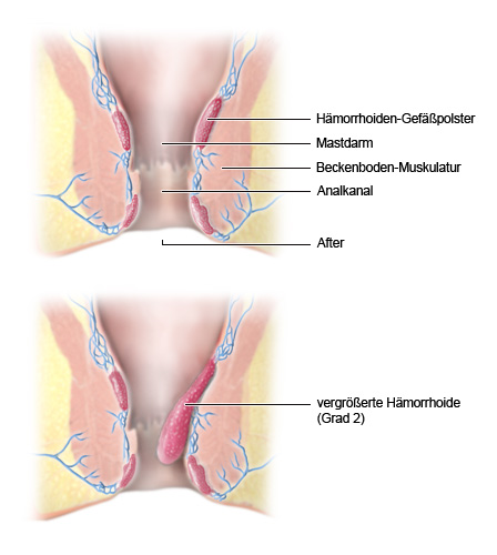 Die zweiteilige vereinfachte anatomische Grafik zeigt Hämorrhoiden-Gewebe im Längsschnitt. Im oberen Teil ist normales Gewebe zu sehen, der untere Teil der Grafik zeigt eine vergrößerte Hämorrhoide (Grad 2), die in den Analkanal ragt.