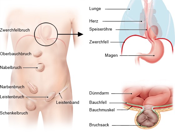 Grafik: Die häufigsten Hernienarten