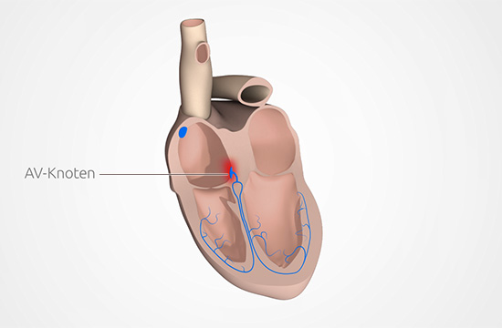Grafik: Beim AV-Block ist die Reizweiterleitung am Herzen gestört