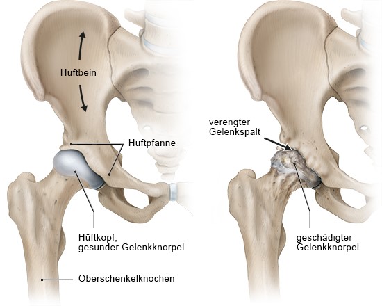 Grafik: links gesundes Hüftgelenk, rechts mit fortgeschrittener Arthrose