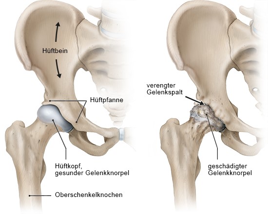 Grafik: gesundes Hüftgelenk (links) und Hüftgelenk mit fortgeschrittener Arthrose (rechts)