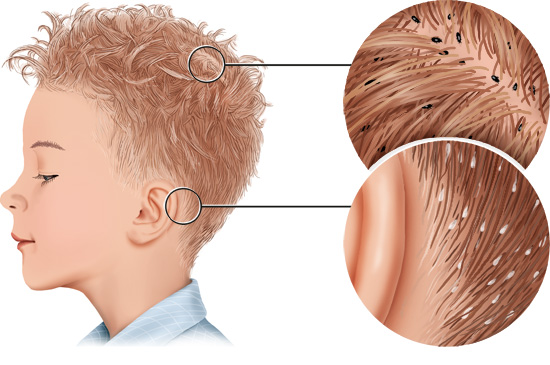 Die Grafik zeigt Kopfläuse am Hinterkopf und Nissen hinter den Ohren: Links im Haar eines Jungen, rechts in Detailansicht.