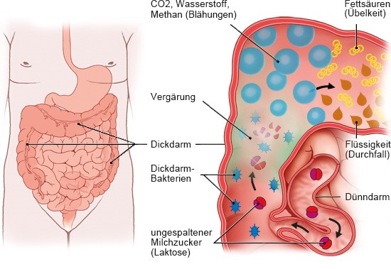 Die Grafik zeigt links die Anatomie des Verdauungssystems und rechts, wie Milchzucker im Dickdarm zersetzt wird und Beschwerden entstehen.