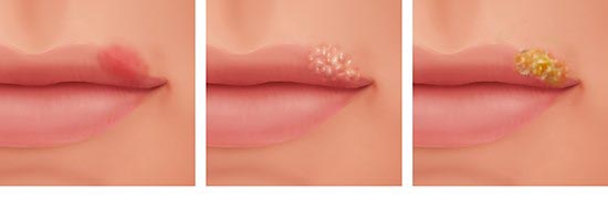 Grafik: Lippenherpes, v.l.n.r.: Rötung, Bläschen, Krusten - wie im Text beschrieben