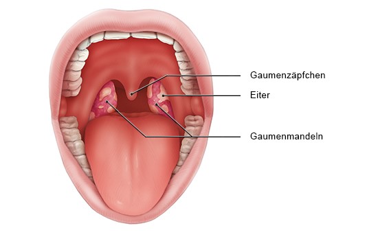 Grafik: Blick in den Mund: Geschwollene, entzündete Mandeln mit Belag