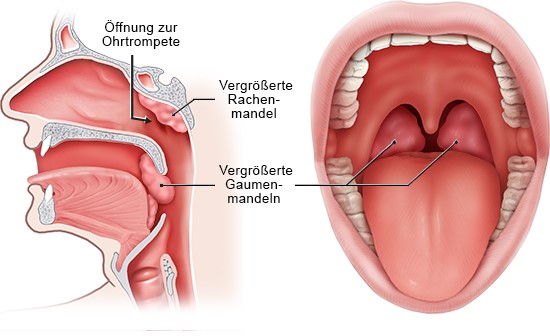 Grafik: Lage der Mandeln. Links: Querschnitt Kopf seitlich, rechts: Blick in den Mund