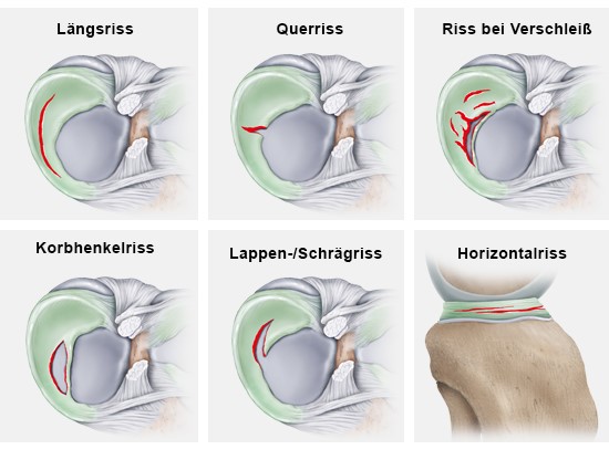 Grafik: Verschiedene Arten von Meniskusrissen (Querschnitte von oben – bis auf rechts unten: Ansicht von der Seite)