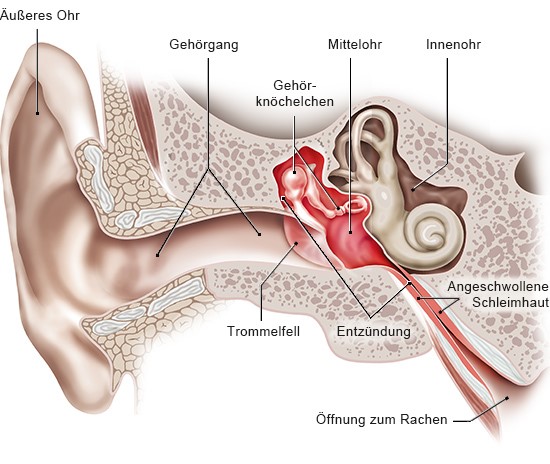Die anatomische Grafik zeigt entzündete und angeschwollene Schleimhäute im Mittelohr.