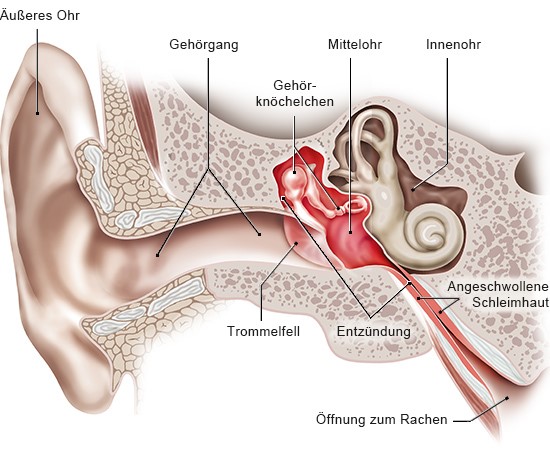 Grafik: Entzündung des Mittelohrs