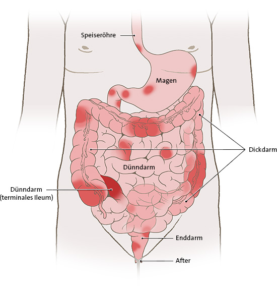Die anatomische Grafik zeigt Bereiche im Darm, am After und im Magen, die bei Morbus Crohn entzündet sein können.