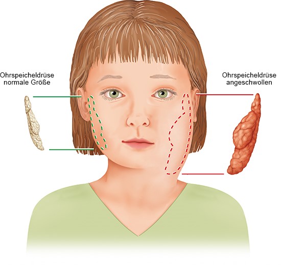 Grafik: Angeschwollene Wange bei Mumps