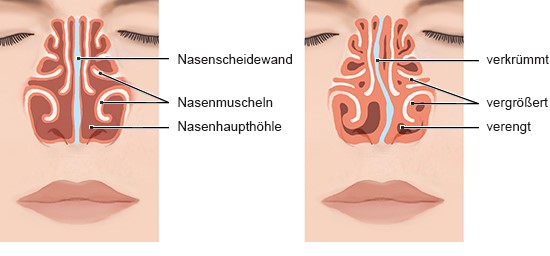 Die Grafik links zeigt eine gerade Nasenscheidewand, die Grafik rechts eine S-förmig verkrümmte Nasenscheidewand.
