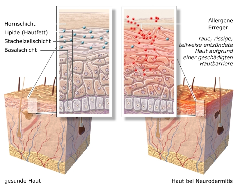 Grafik: Gesunde Haut und Haut mit Neurodermitis - wie im Text beschrieben