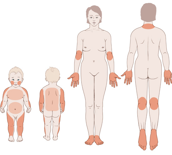 Grafik: Neurodermitis bei Kindern und Erwachsenen: alterstypische Hautstellen - wie im Text beschrieben