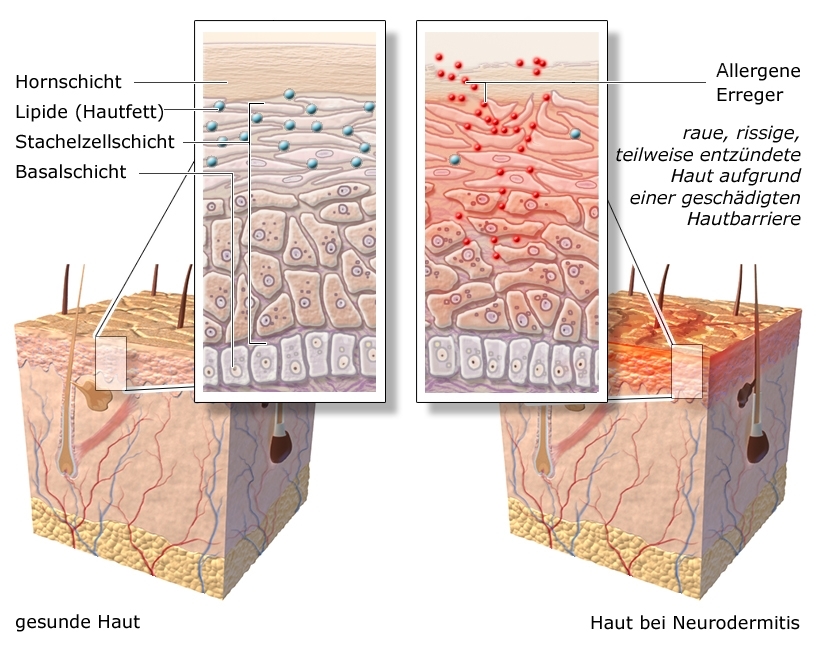 Die anatomische Grafik zeigt den Aufbau der Hautschichten mit Detailansicht: Links bei gesunder Haut, rechts bei von Neurodermitis betroffener Haut.