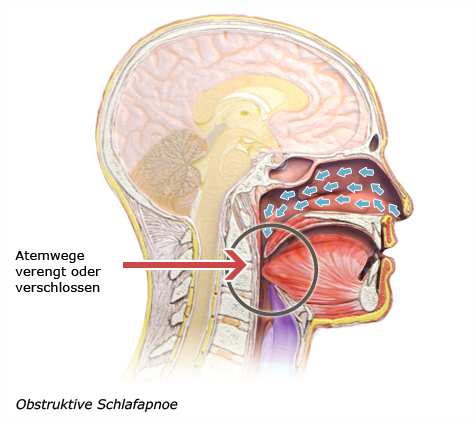Grafik: Obstruktive Schlafapnoe - wie im Text beschrieben