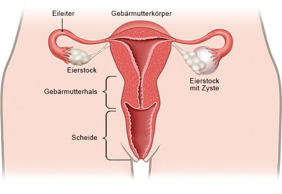 Grafik: Eierstock mit Zyste