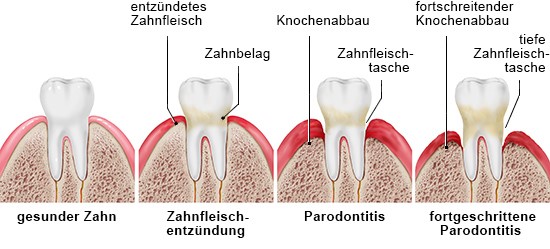 Grafik: gesunder Zahn, Zahnfleischentzündung und Parodontitis