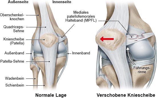 Grafik: Normale Anatomie des Knies (links) und Patella-Luxation (rechts)