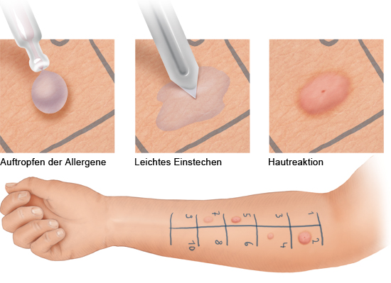Grafik: Ablauf eines Prick-Tests - wie im Text beschrieben