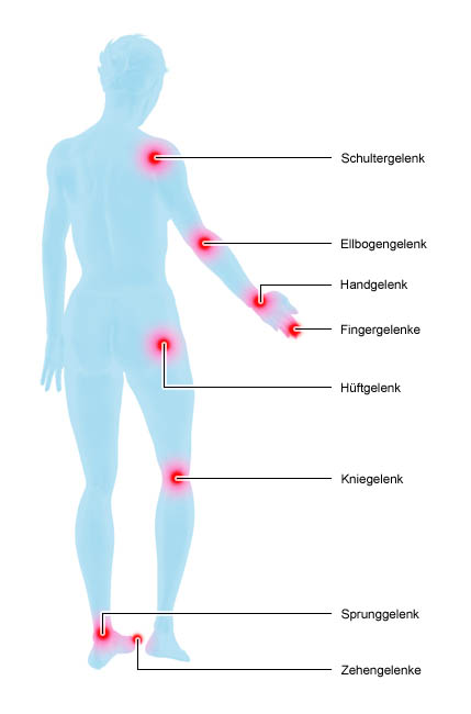 Grafik: häufig von Rheuma betroffene Gelenke