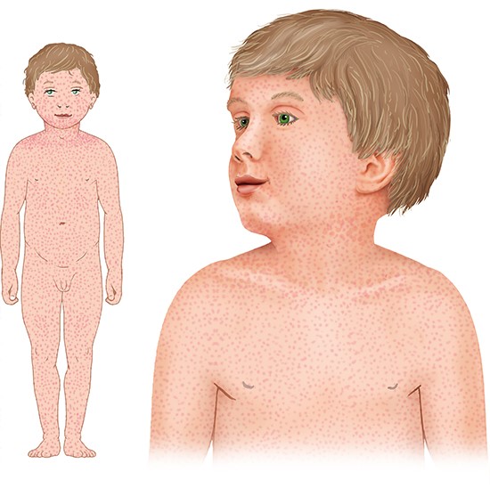 Grafik: Typischer Hautausschlag bei Röteln