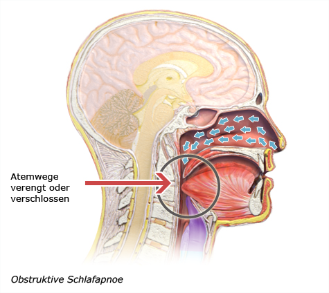 Die vereinfachte anatomische Grafik zeigt die Verengung der Atemwege bei einer obstruktiven Schlafapnoe anhand eines Querschnitts des Kopfes.