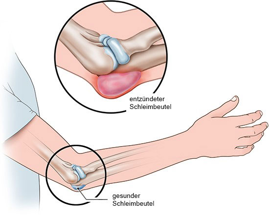 Grafik: Gesunder und entzündeter Schleimbeutel am Ellenbogen