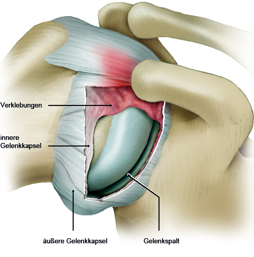 Grafik: Schultersteife: Narbenähnliche Verklebungen in der Gelenkkapsel - wie im Text beschrieben