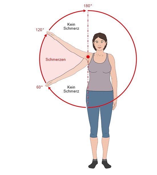 Grafik: Schmerzhafter Bereich bei Schmerzen unter dem Schulterdach