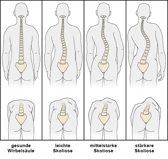Grafik: Skoliose: Beim Vorbeugetest sichtbare Verkrümmungen der Brustwirbelsäule