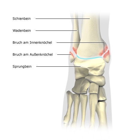 Grafik: Bruch am Innen- und Außenknöchel, Ansicht von oben