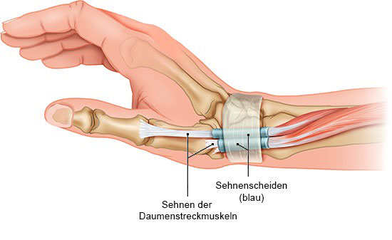 Grafik: Sehnen werden von Sehnenscheiden geschützt