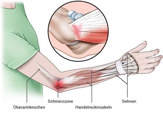 Grafik: Schmerzregion bei Tennisarm - wie im Text beschrieben