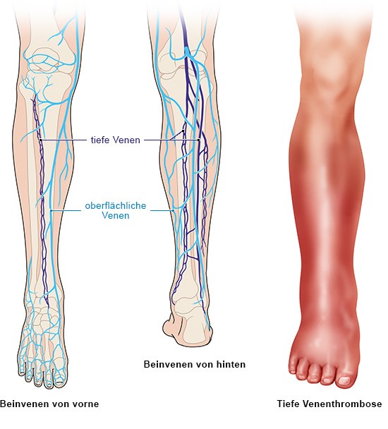 Die Grafik zeigt ein gesundes Bein mit oberflächlichen und tiefen Venen und einen geröteten Unterschenkel mit einer tiefen Venenthrombose.