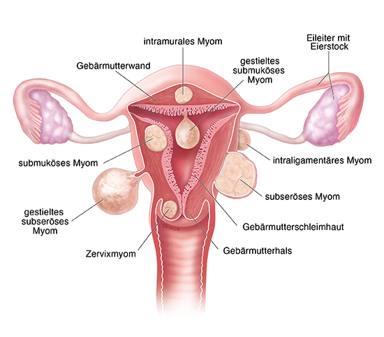 Grafik: Verschiedene Formen von Myomen