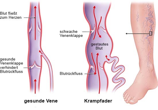 Grafik: Blutrückfluss bei Krampfadern am Bein