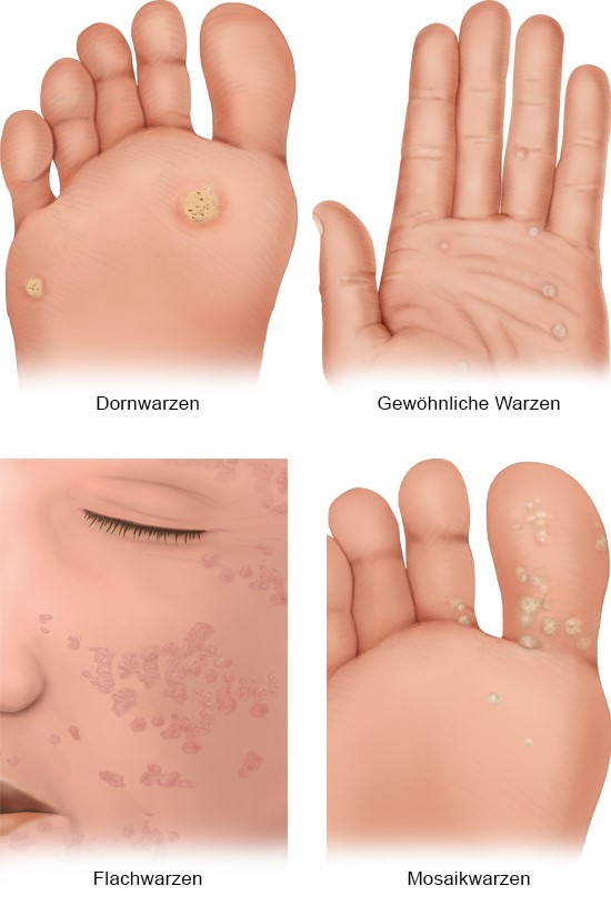 Grafik: Häufige Warzentypen