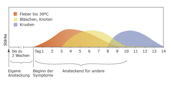 Windpocken: Verlauf und Ansteckungszeiten