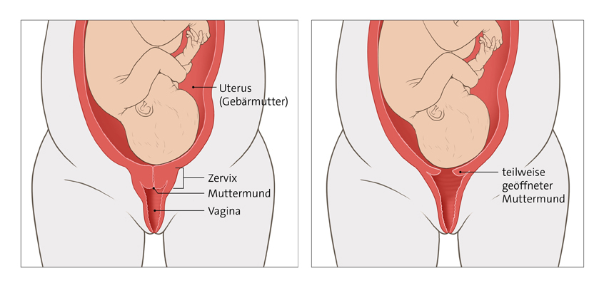 Die Grafik links zeigt ein Kind in der Gebärmutter bei geschlossenem Muttermund, rechts bei teilweise geöffnetem Muttermund.